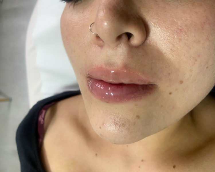 5 sesiones de hydralips