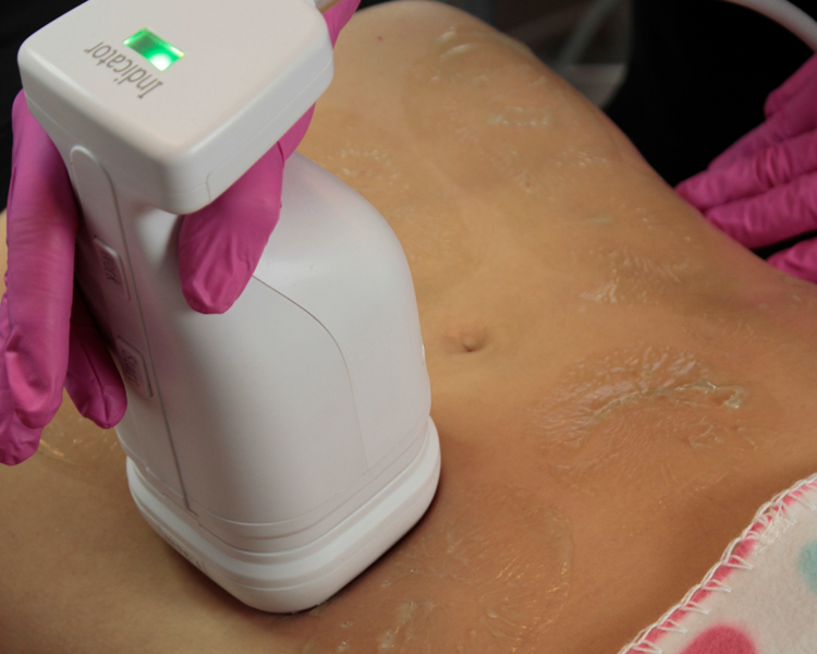 LIPOSONIX ABDOMEN Y FLANCOS 