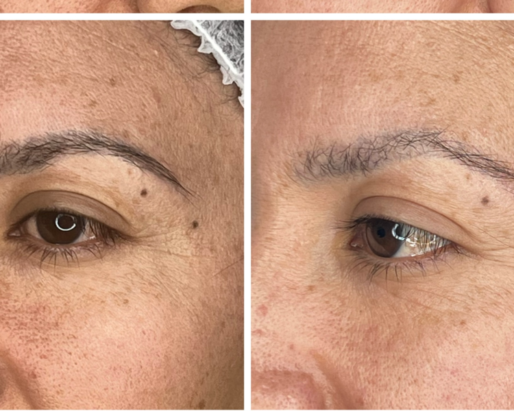 Remoción/Eliminación de Microblading Antiguo Pack 4 sesiones