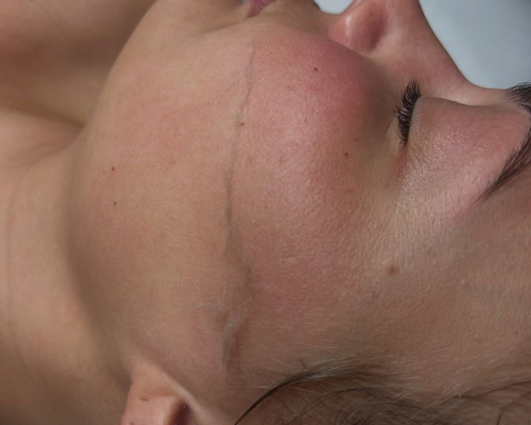 Dermaplaning con Limpieza