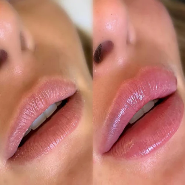 BB Lips (3 Sessions)