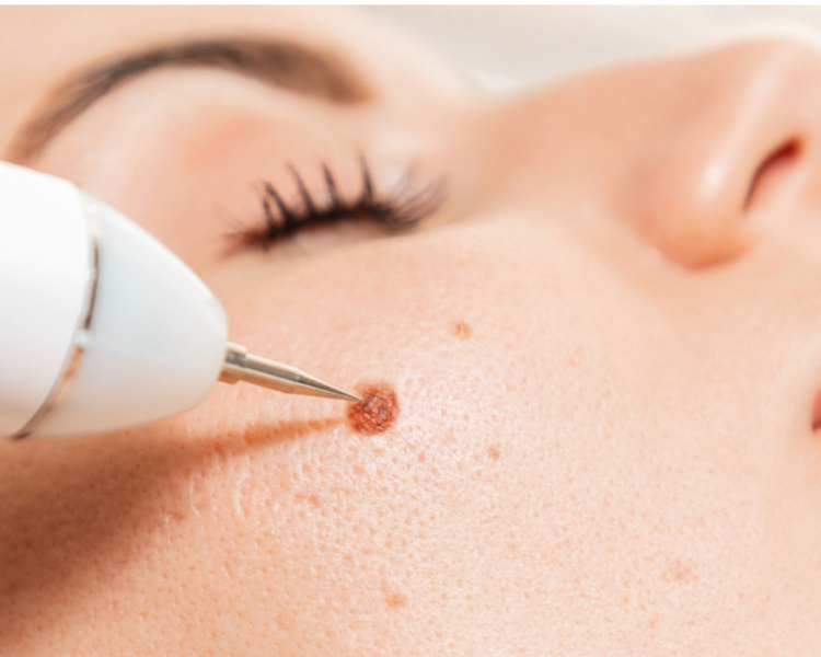 Retiro de verrugas con plasma pen