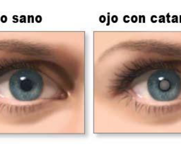 CIRUGIA DE CATARATAS FACO POR OJO TODO INCLUIDO