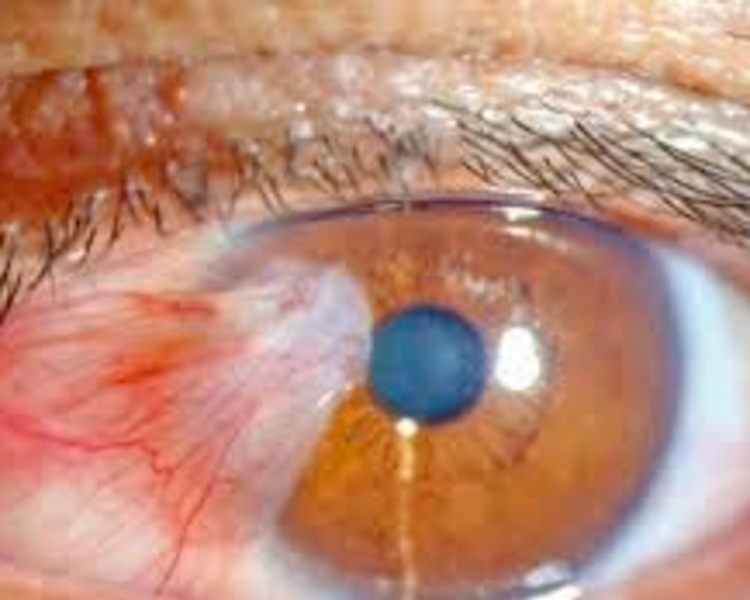 CIRUGIA PTERGION (CARNOSIDAD)