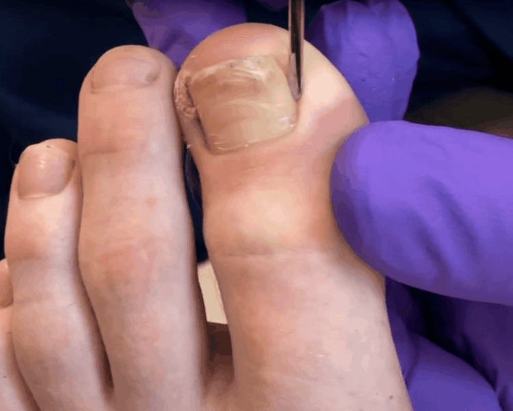 Uña encarnada (onicocriptosis - Valor por surco)