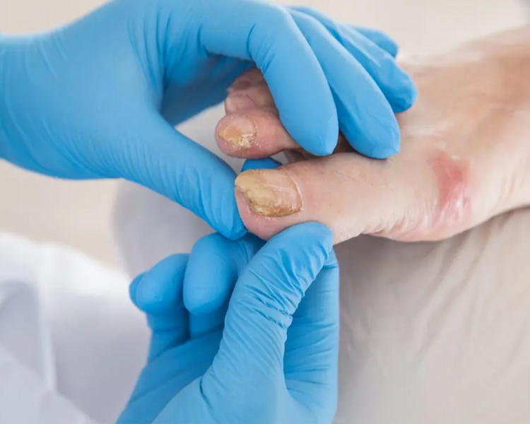Tratamiento de hongos en uñas 