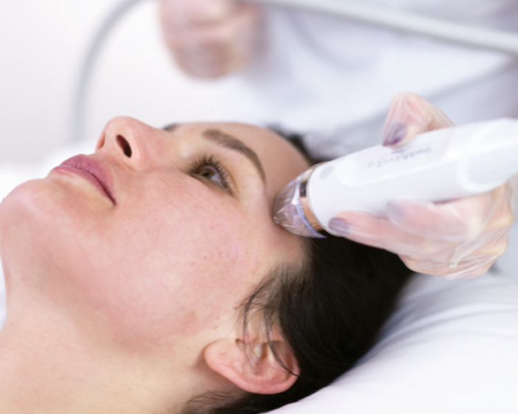 RADIOFRECUENCIA FRACCIONADA 3 SESIONES CABEZAL INTENSIF  