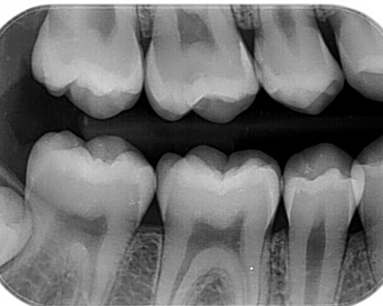 RADIOGRAFIA BITE WING 