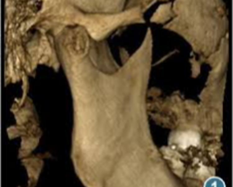 TOMOGRAFIA  CBCT ATM BILATERAL 