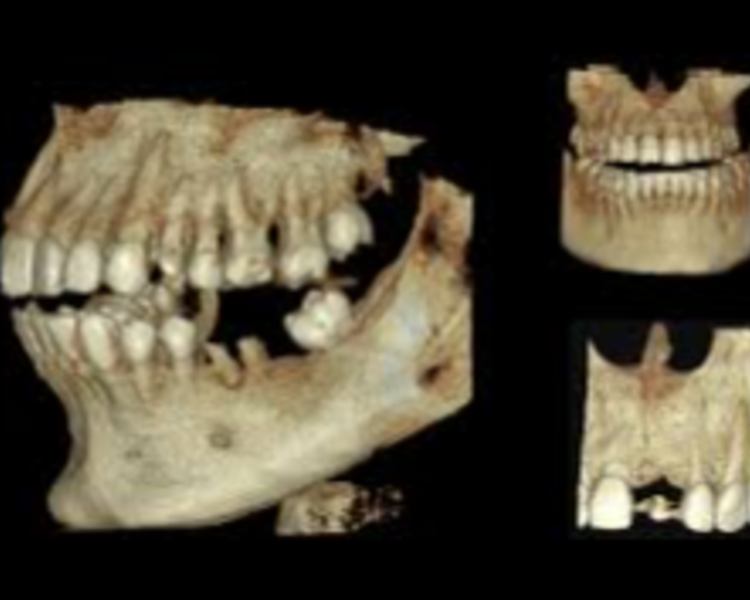 TOMOGRAFIA CONE BEAM DE UN DIENTE O ZONA