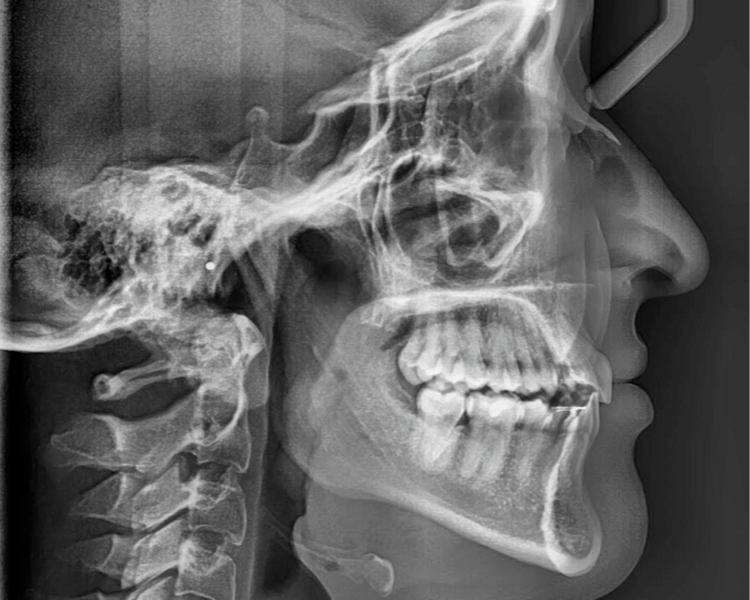TELERRADIOGRAFIA O RX LATERAL DE CRANEO