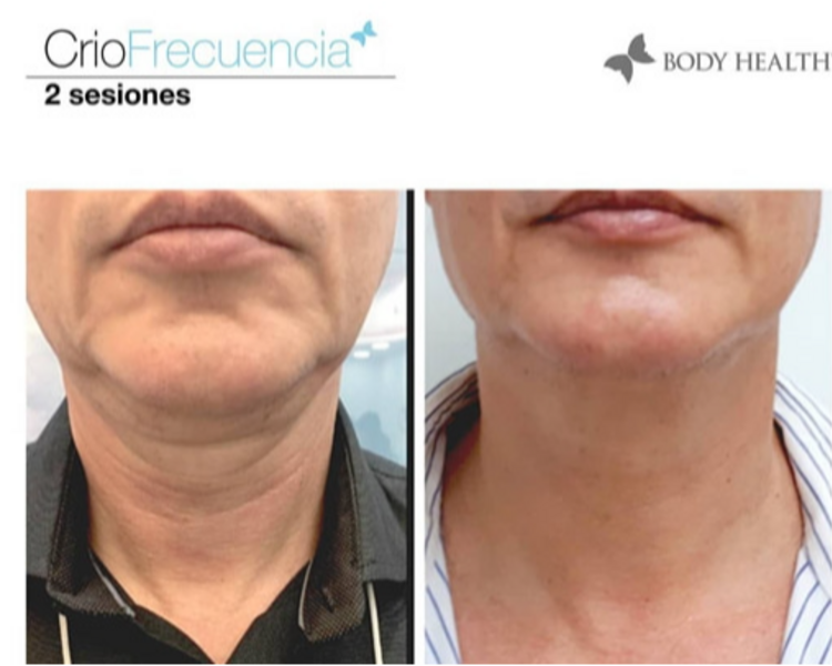 CRIORADIOFRECUENCIA FACIAL 