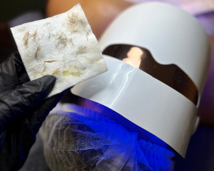 Limpieza facial con peeling o dermaplaning