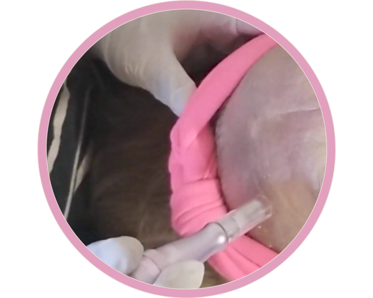 Facial Fresh (micronedling)