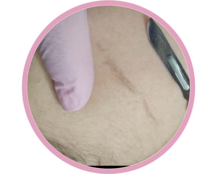 Glow up (dermaplaning)