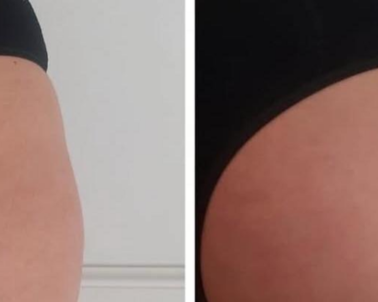 HIFU 12 PRO MAX PIERNAS