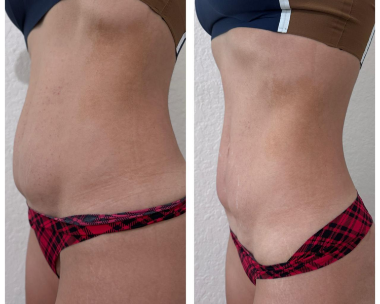 HIFU 12 PRO MAX ABDOMEN COMPLETO