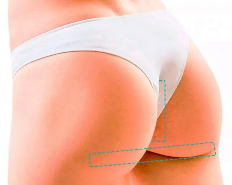 Depilación Intergluteo