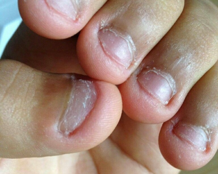 Esculpidas para uñas con ONICOFAGIA