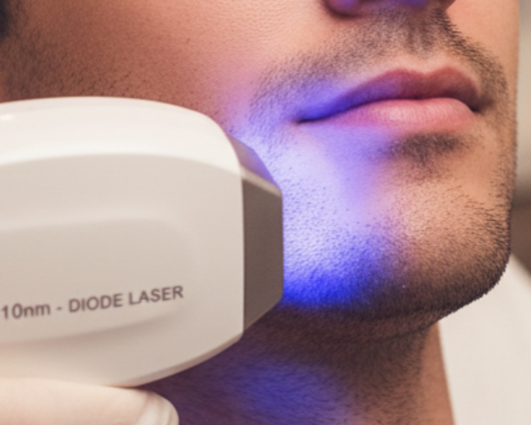 Diodo Barba 1 sesión