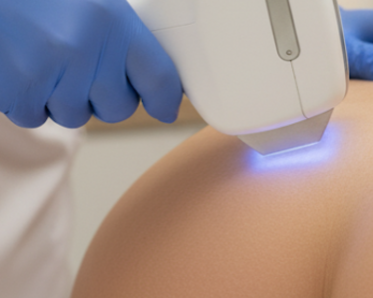 Diodo Glúteos 1 sesión