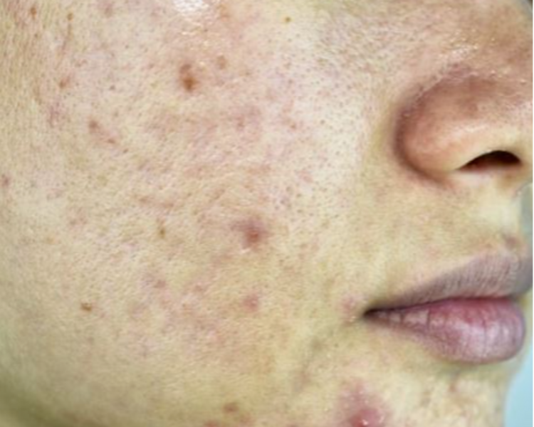 Pack limpieza Acné 4 sesiones 