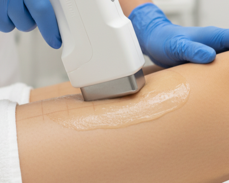 Hifu Piernas 1 sesión