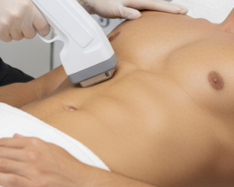 Hifu Cuerpo Completo 1 Sesión