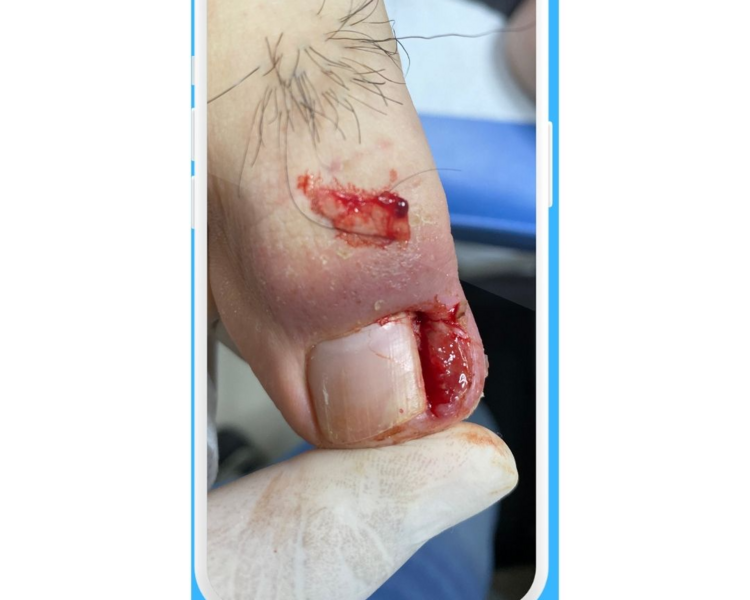 Onicocriptosis sin Dolor