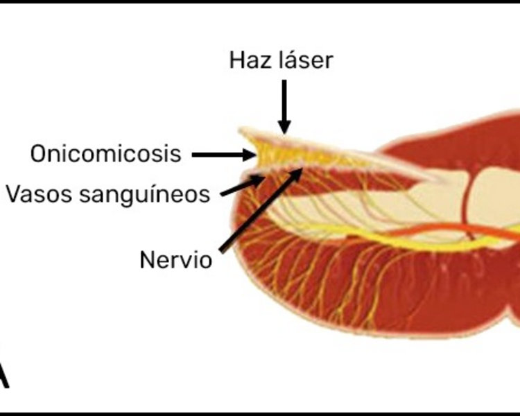 Tratamiento de Laserterapia