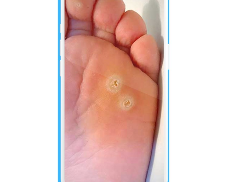 Atención de Verruga Plantar 