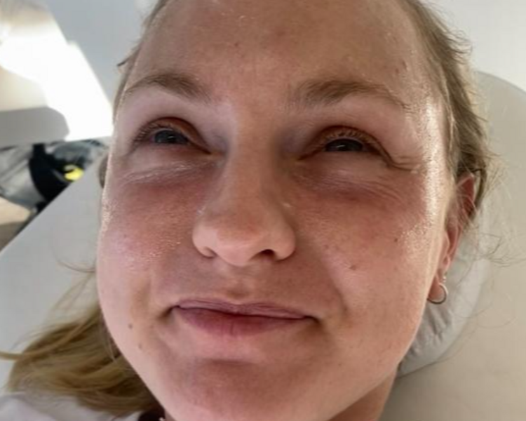 OJERAS CON HIALURONICO