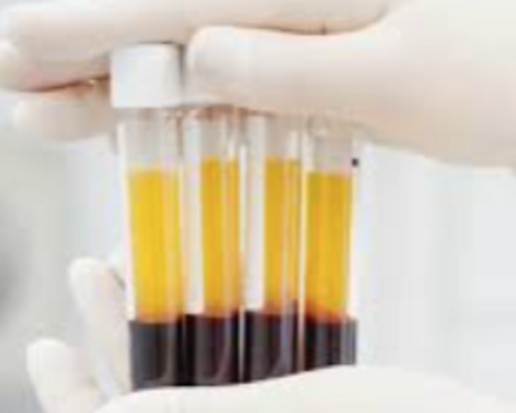 PLASMA RICO EN PLAQUETAS