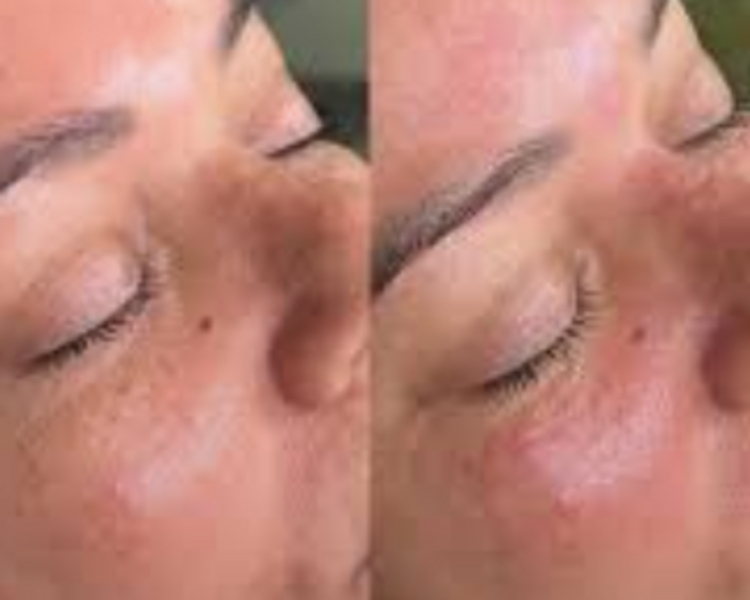 MESOTERAPIA CON PDRN DE SALMON