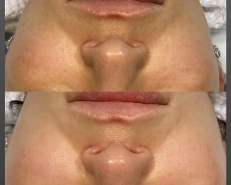 Facial Limpieza Profunda