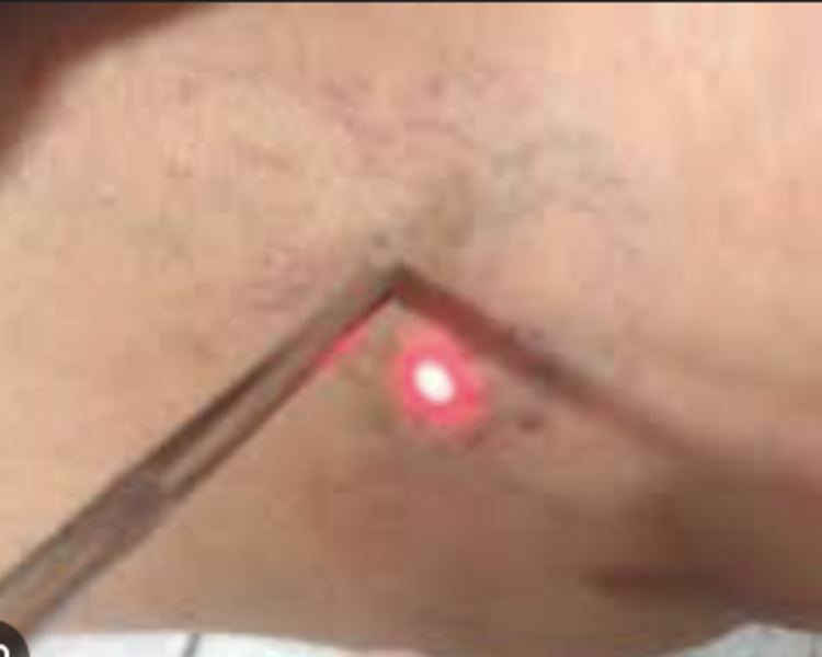 VARICES LASER