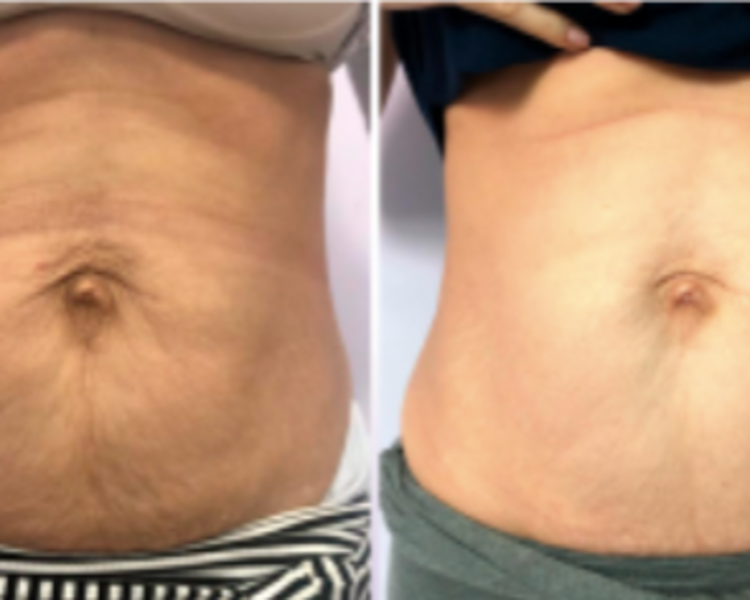 BIOESTIMULACION CORPORAL