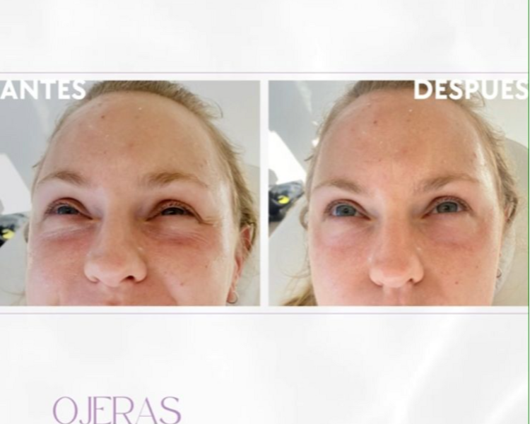 PROMO REJUVENECE MIRADA: TOXINA BOTULINICA+ OJERAS