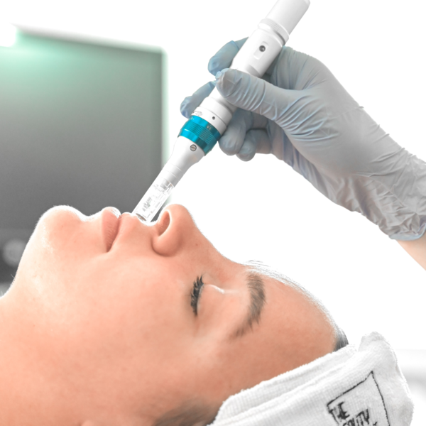 Peeling Quimico + Dermapen