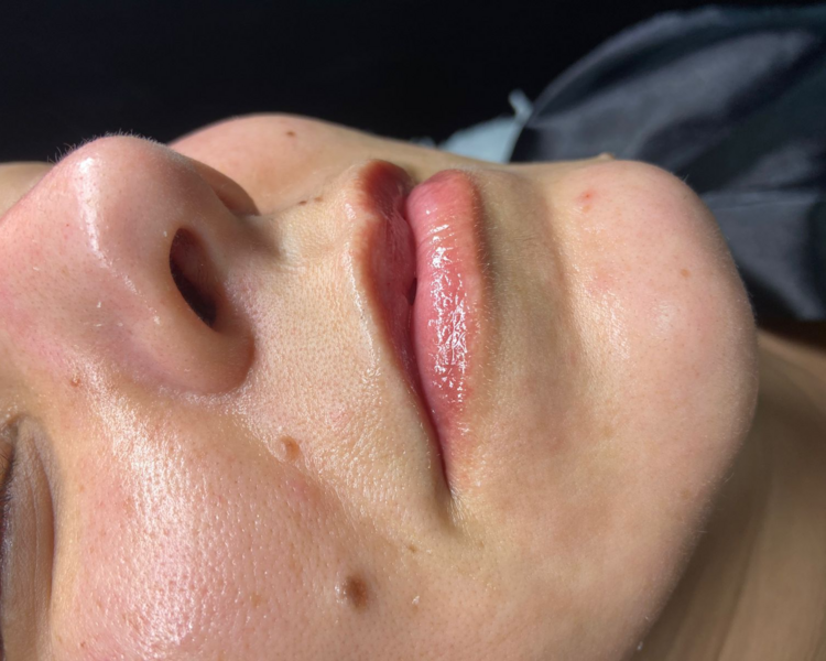 Hidratación de Labios con Hialuronico