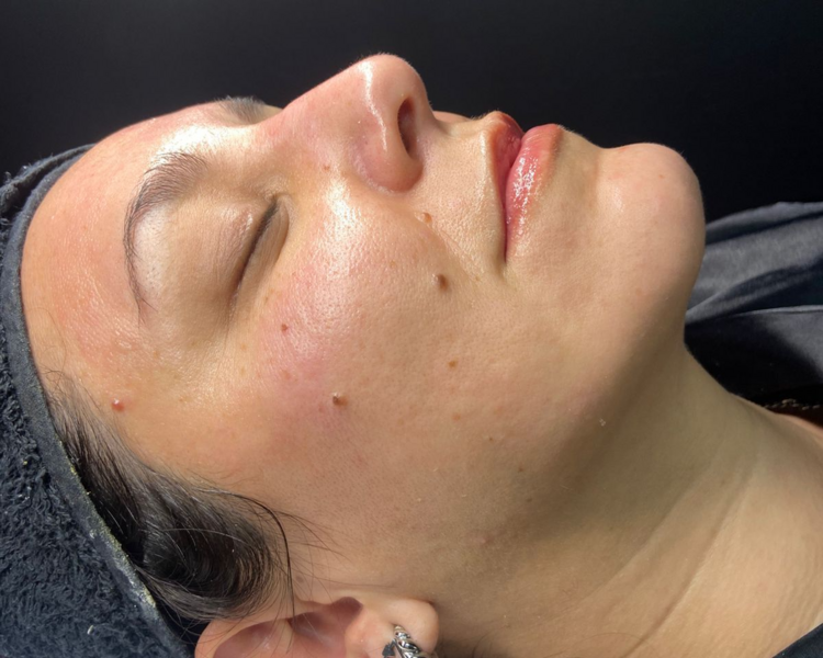 Hilos de colageno- Tensor