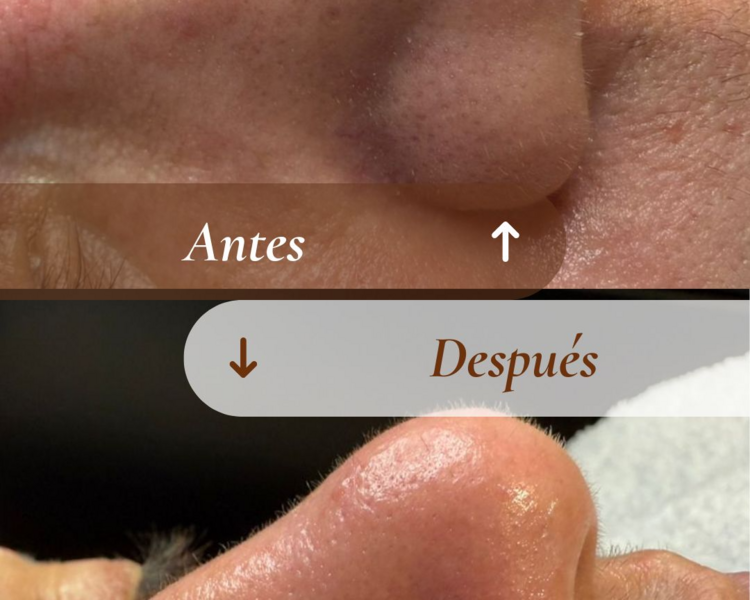 Adicional zona de extracción