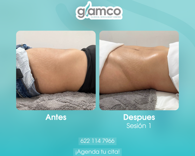 Lipo Drenaje Brasileño