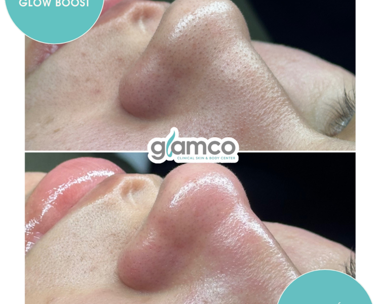 Limpieza Facial Personalizada