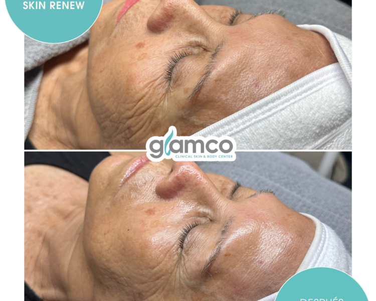 Rejuvenecimiento Instantaneo