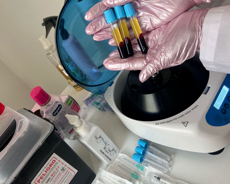 Mesoterapia capilar con plasma