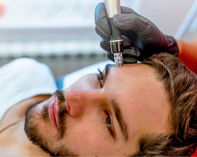 Dermapen - Microneedling CAPILAR 