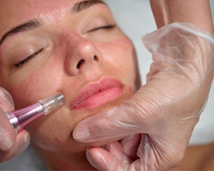 Dermapen - Microneedling Facial