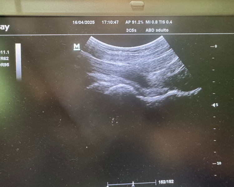 Bloqueo con Corticoides