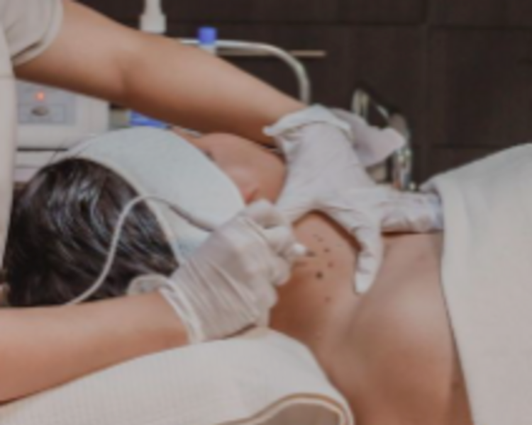 Cauterización de Lunares y verrugas